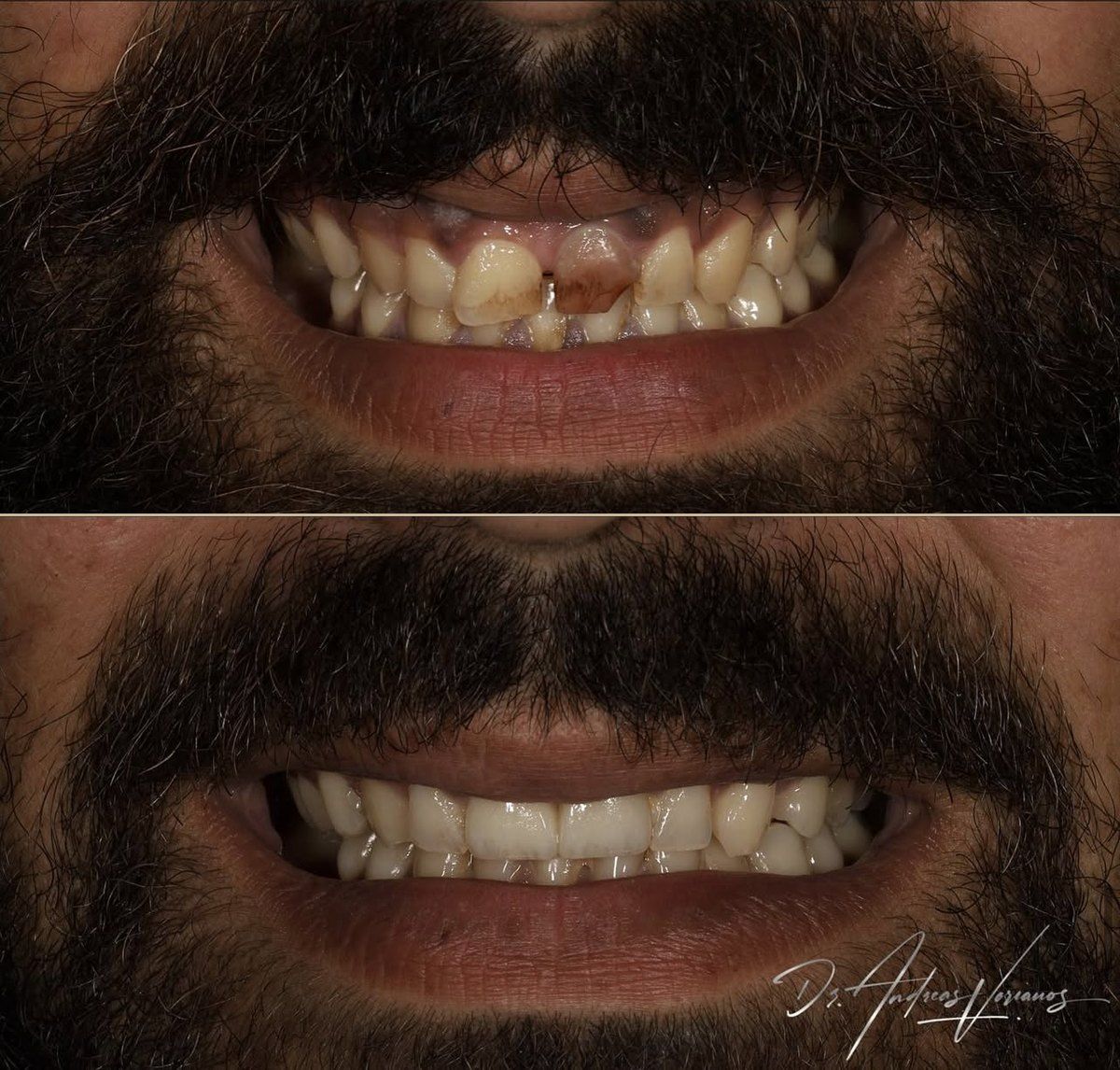 As natural as possible &mdash; before above, after below