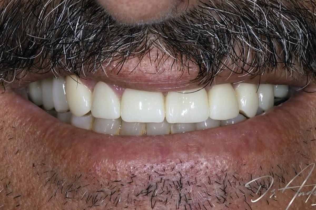 Raising the bite — after treatment by Dr Andreas Varianos