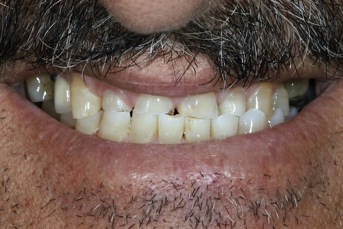 Raising the bite — before treatment
