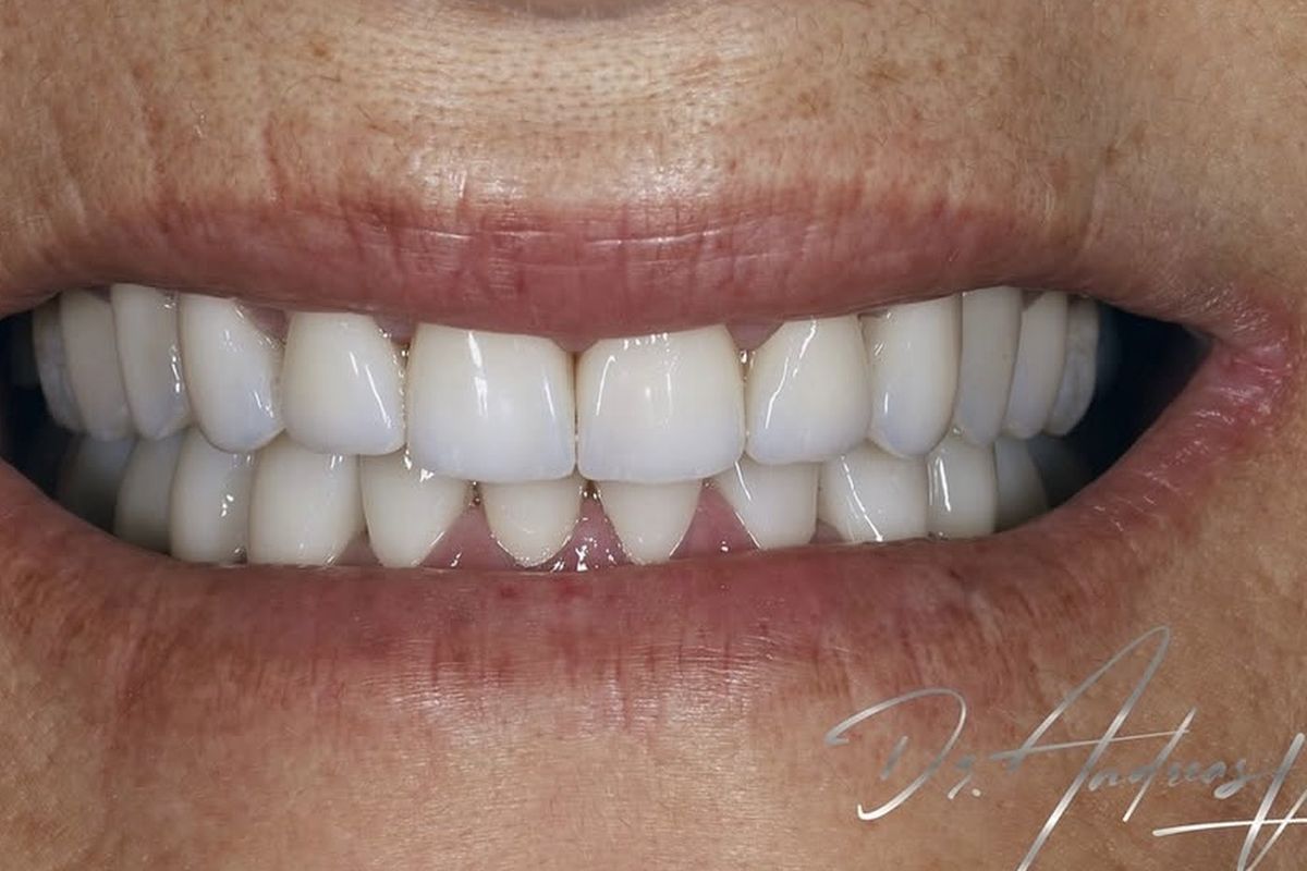 Dental ceramics — after treatment by Dr Andreas Varianos