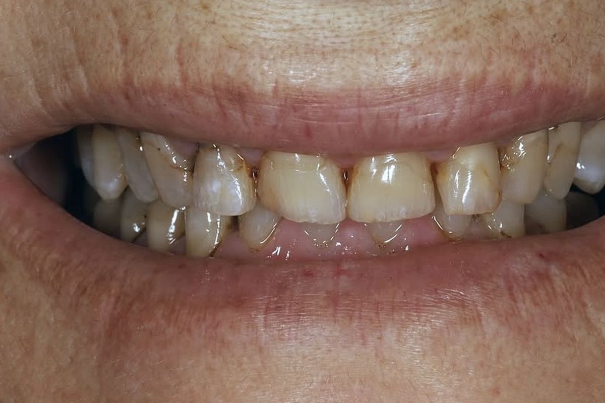 Dental ceramics — before treatment