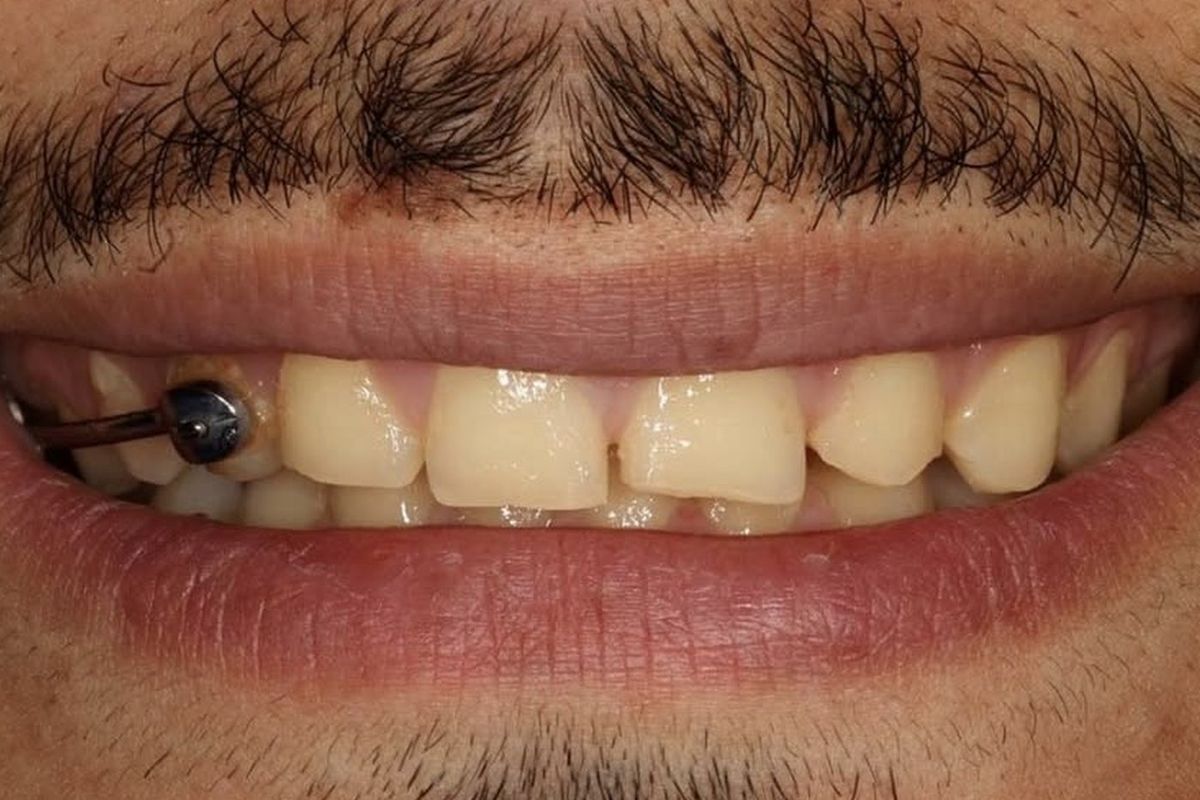 IPS e.max Press &mdash; before