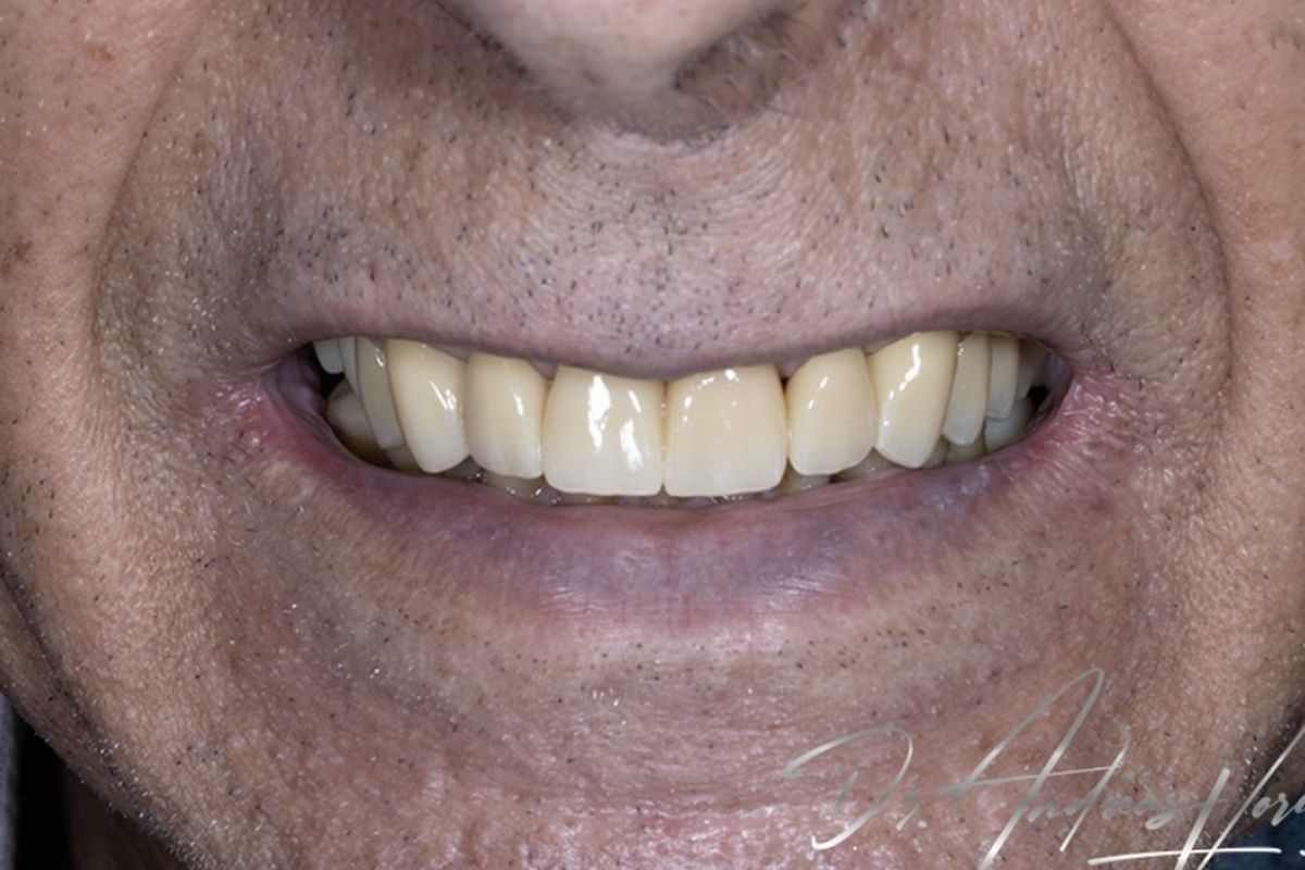 Restoring function — after treatment by Dr Andreas Varianos