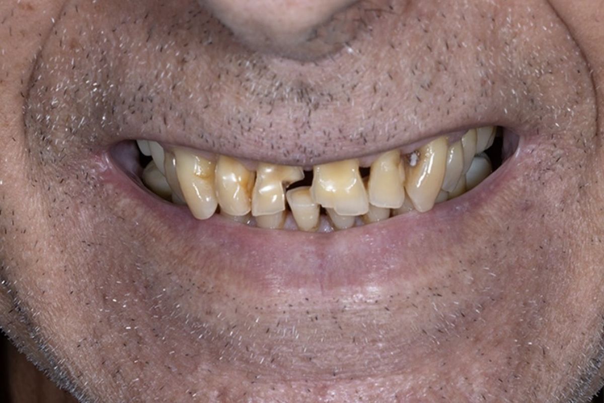 Restoring function — before treatment