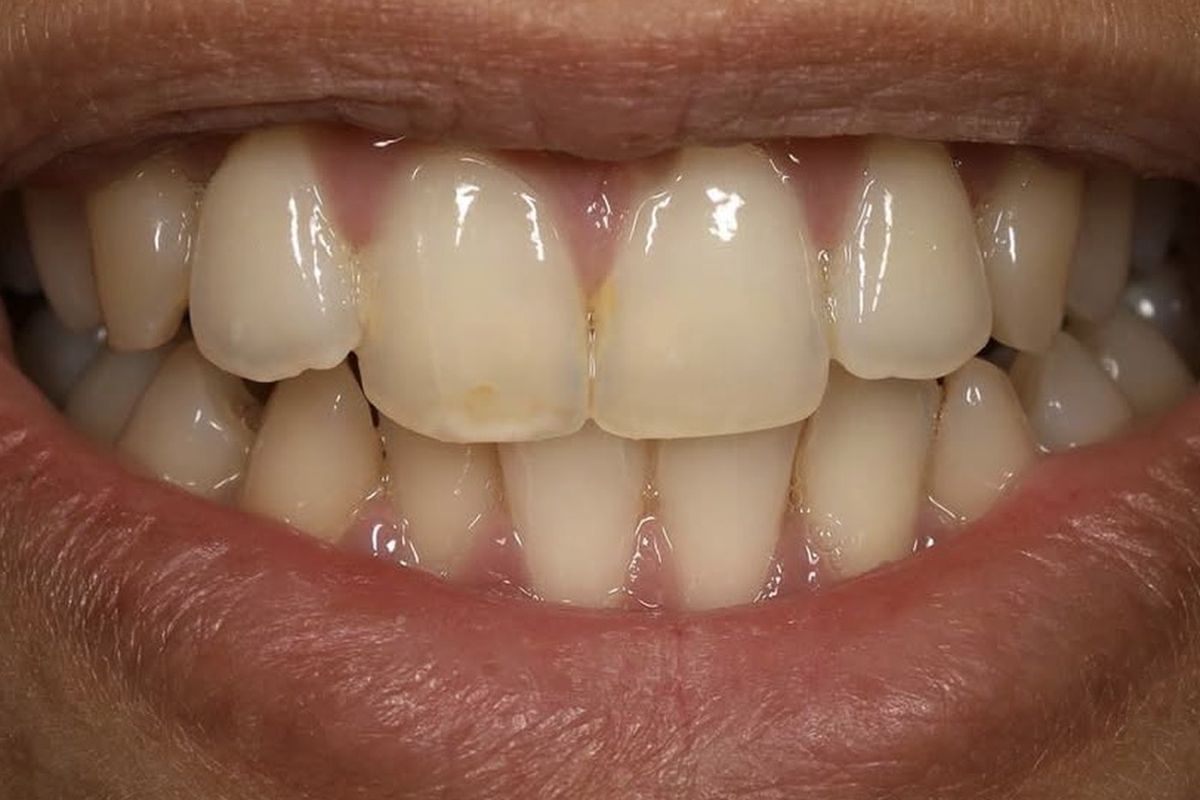 Natural results &mdash; before