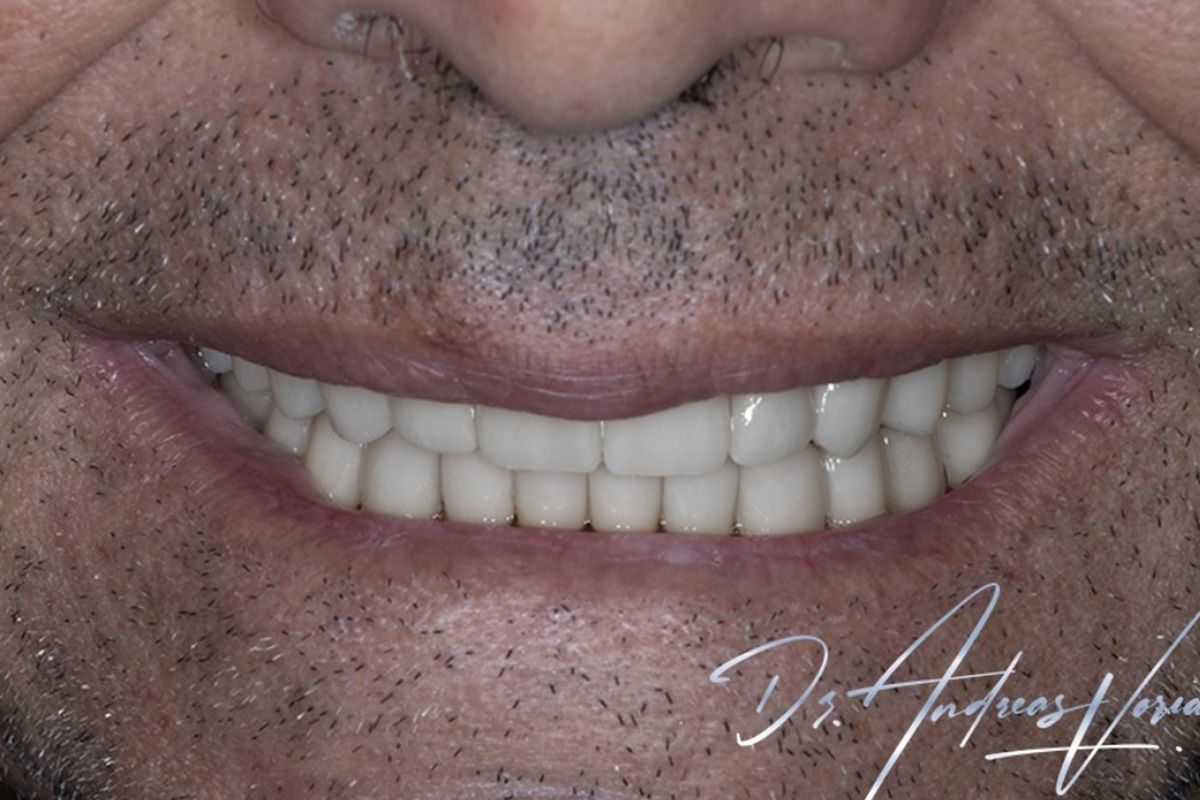 Full mouth rehabilitation — after treatment by Dr Andreas Varianos