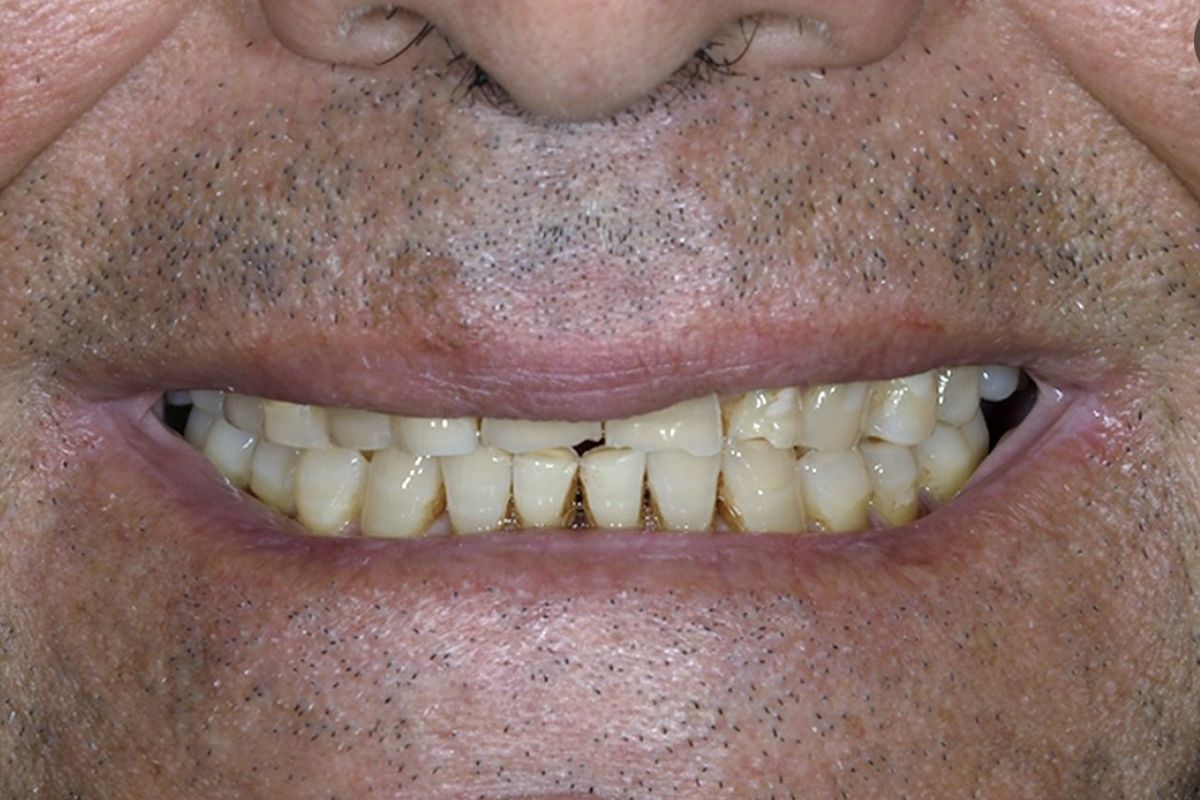 Full mouth rehabilitation — before treatment