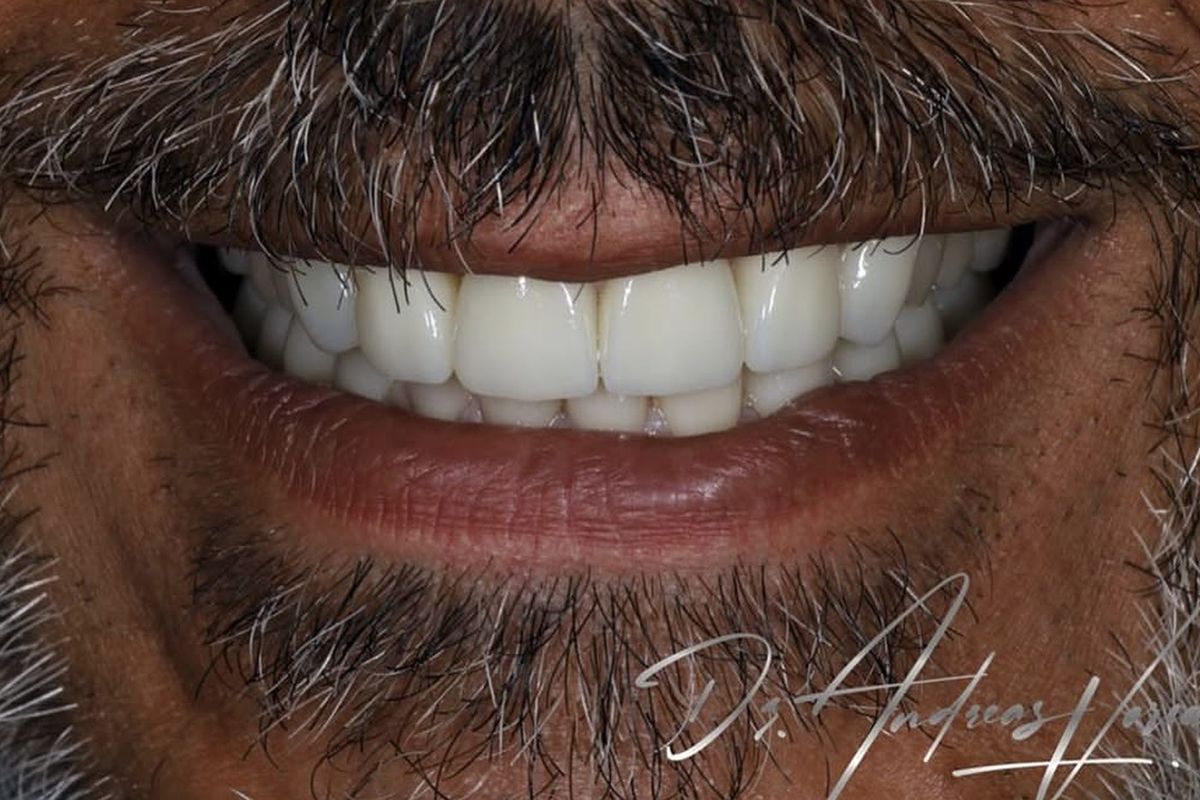 The same smile after treatment by Dr Andreas Varianos