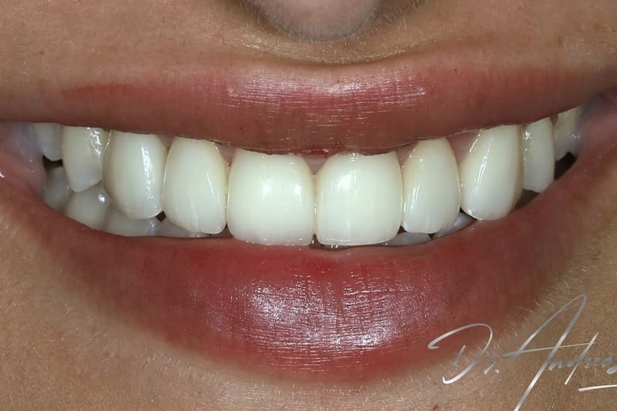 Glass-ceramic veneers — after treatment