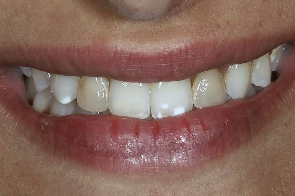 Glass-ceramic veneers — before treatment
