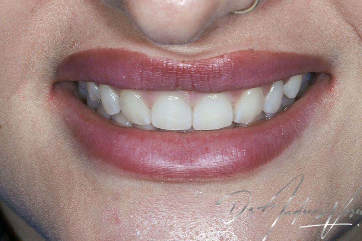 Veneers &mdash; after