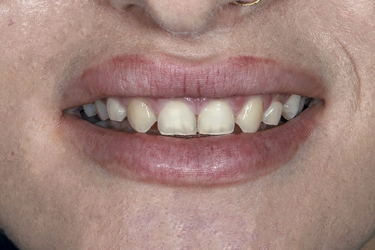Veneers &mdash; before