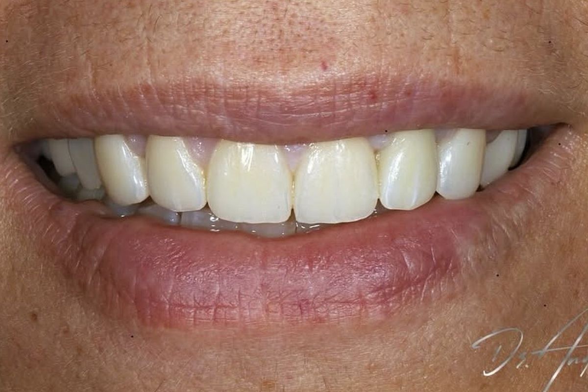 Zirconia on natural shades — after treatment by Dr Andreas Varianos