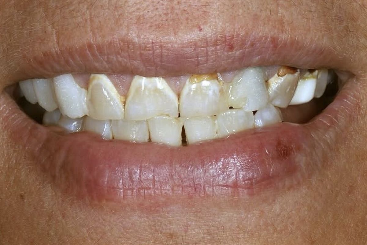 Zirconia on natural shades — before treatment